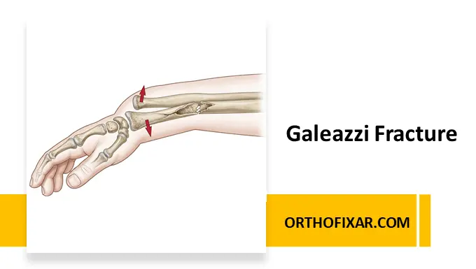 Galeazzi Fracture