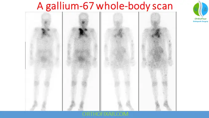 Bone Scan Radionuclide Imaging: Principles, Applications & Interpretation 8 Gallium-67 Imaging