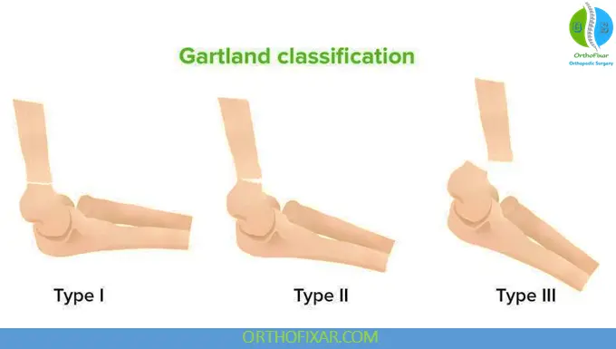 Gartland Classification Pediatric Supracondylar Humerus Fractures
