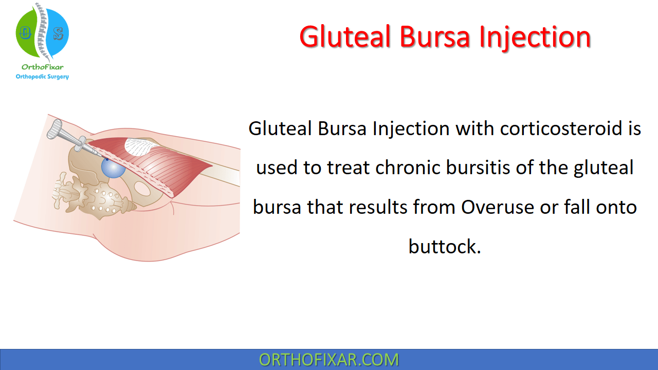 Gluteal Bursa Injection