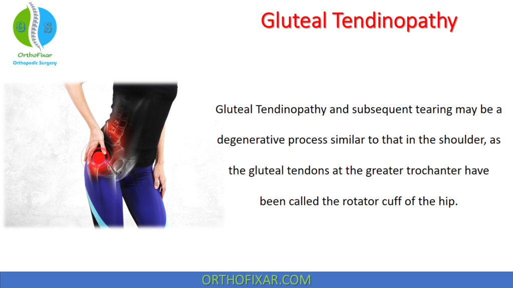 Gluteal Tendinopathy Easy Explained OrthoFixar 2026
