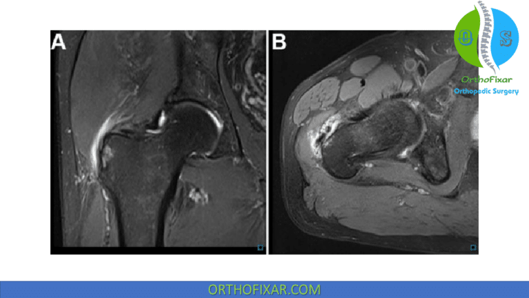 Gluteal Tendinopathy - Easy Explained | OrthoFixar 2024