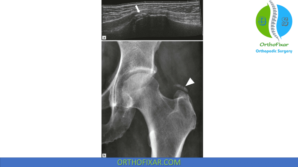 Gluteal Tendinopathy - Easy Explained | OrthoFixar 2024