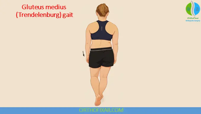 Gluteus Medius Gait (Trendelenburg Gait)