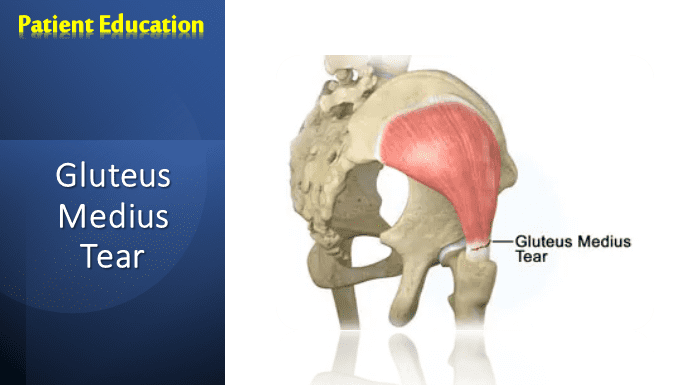 Gluteus Medius Tear