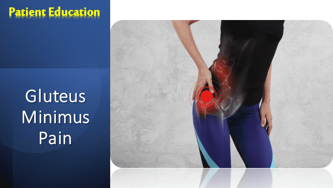 Gluteus Minimus Pain Treatment | 2025