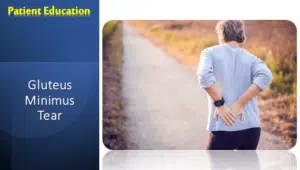 Gluteus Minimus Tear | Symptoms & Treatment
