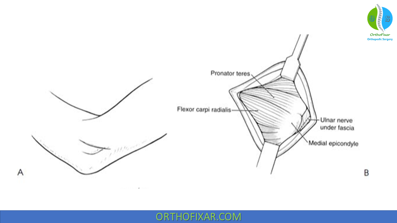 Golfer Elbow Surgery OrthoFixar 2024