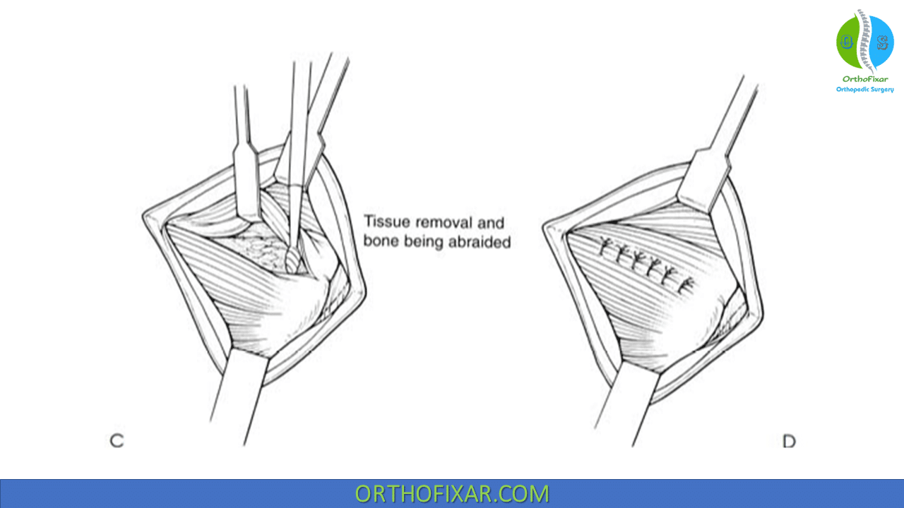 Golfer Elbow Surgery OrthoFixar 2024