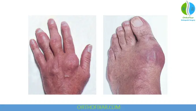 Gout signs