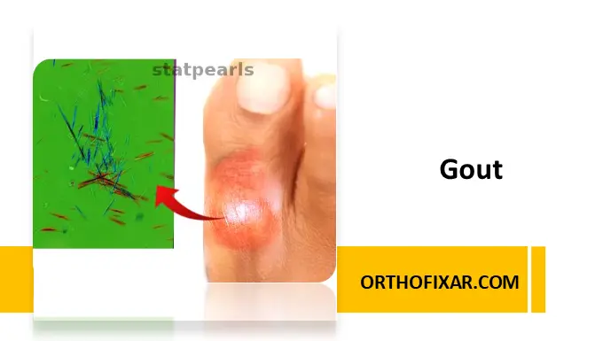 Gout