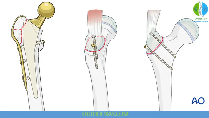 Greater Trochanteric Fractures treatment options
