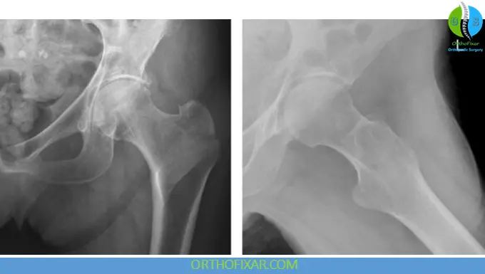 Greater Trochanteric Fractures xray