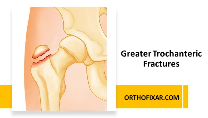 Greater Trochanteric Fractures