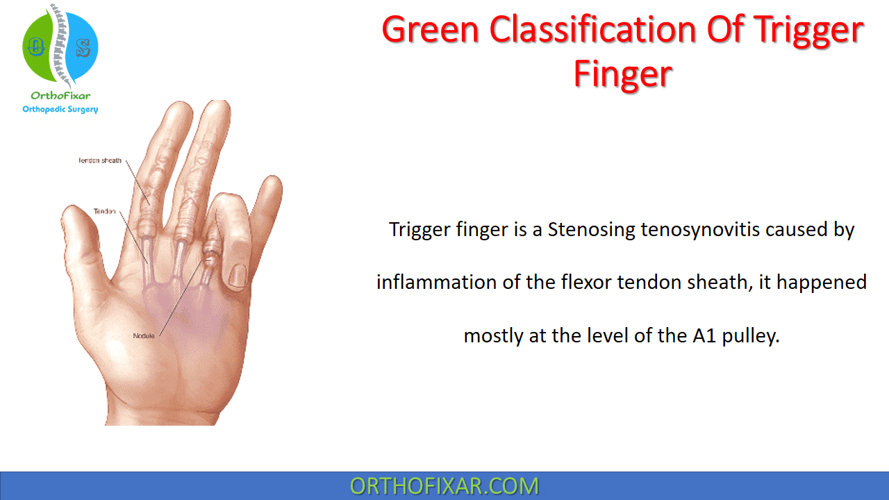  Green Classification of Trigger finger 