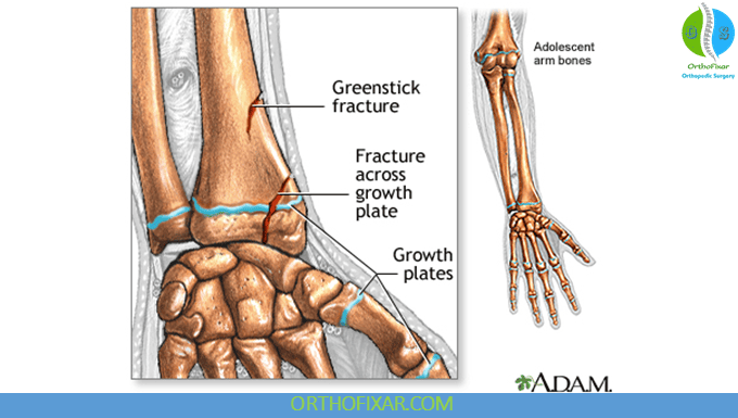 Growth Plate Fracture