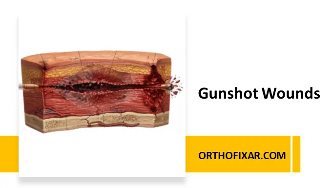 Gunshot Wounds Ballistics, Pathophysiology, and Management