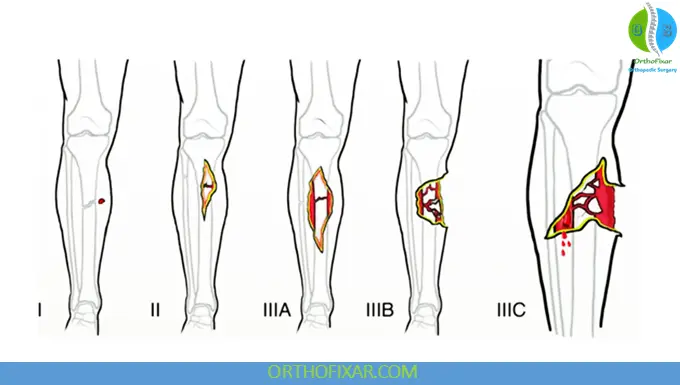 Gustilo-Anderson Classification 3 Gustilo-Anderson Classification