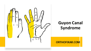 Guyon Canal Syndrome Overview