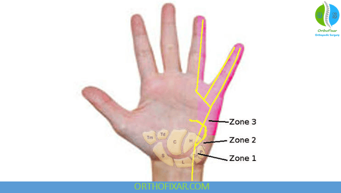 Guyons canal syndrome Three Zones of Compression