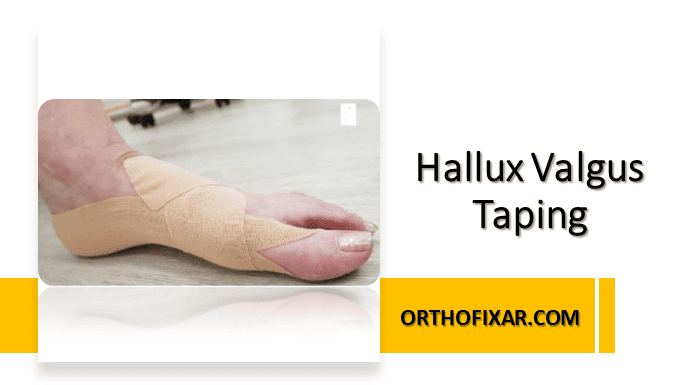 Hallux Valgus Taping Techniques