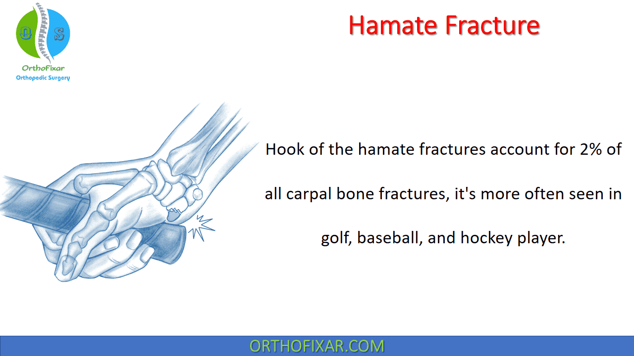  Hamate Fracture 