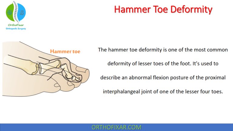 Hammer Toe Deformity