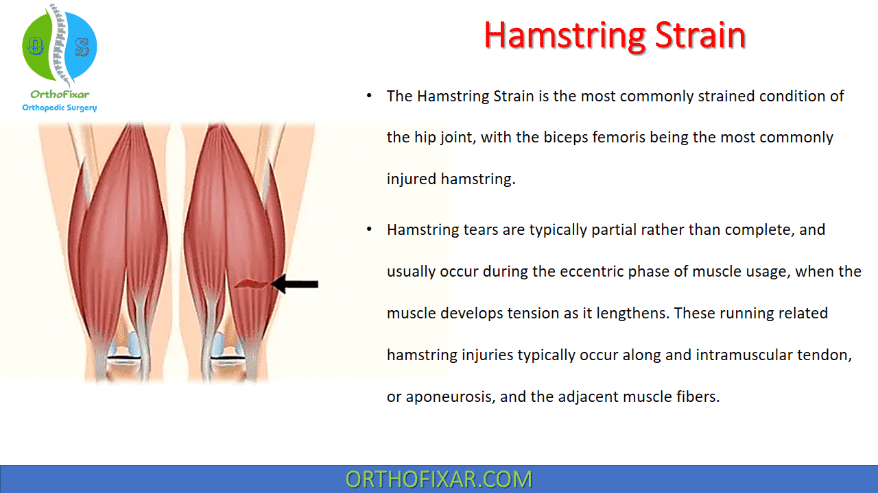  Hamstring Strain 