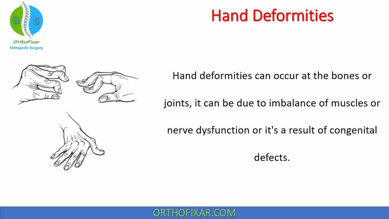  Hand Deformities 
