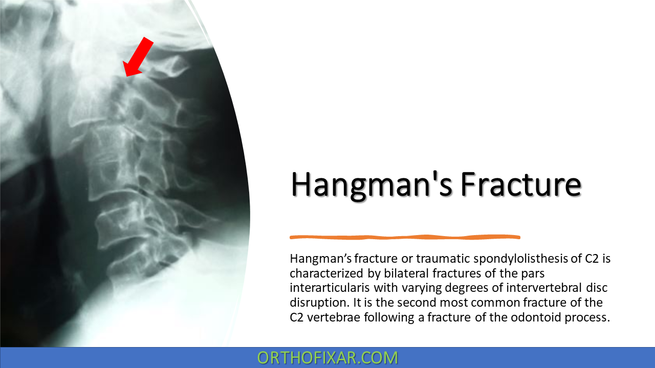  Hangman’s Fracture 
