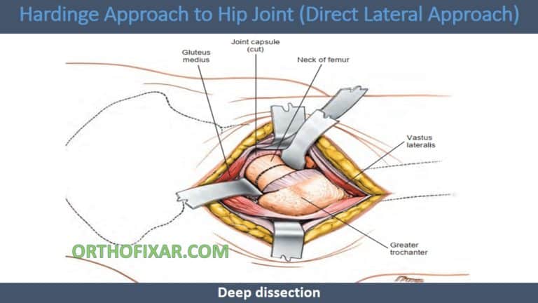 Direct Lateral Harding Approach Hardinge Approach (Direct Lateral) To The Hip: Technique, Indications ...