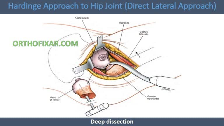 Direct Lateral Harding Approach Hardinge Approach (Direct Lateral) To The Hip: Technique, Indications ...