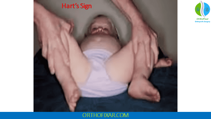 Hart’s Sign for DDH
