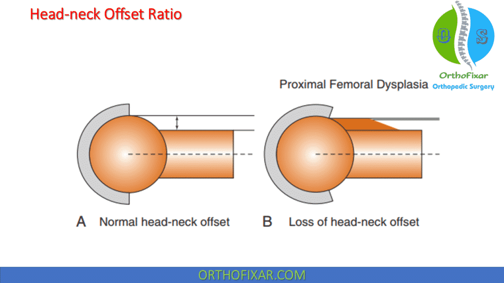 Head-neck Offset Ratio