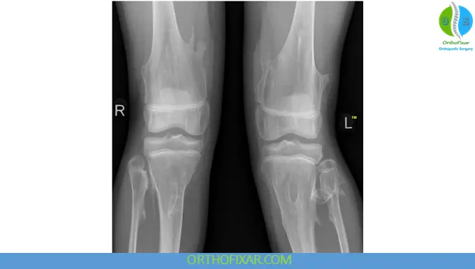 Hereditary Multiple Exostoses xray