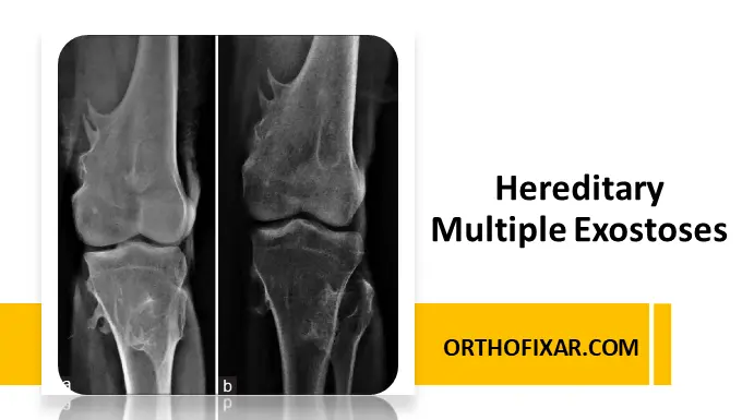 Hereditary Multiple Exostoses