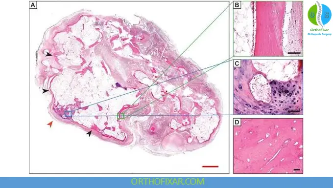 Heterotopic Ossification: Pathophysiology, Classification, Diagnosis & Treatment 7 Heterotopic ossification Histopathology