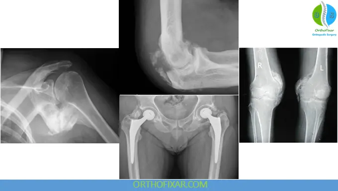 Heterotopic Ossification: Pathophysiology, Classification, Diagnosis & Treatment 9 Heterotopic ossification in the joints