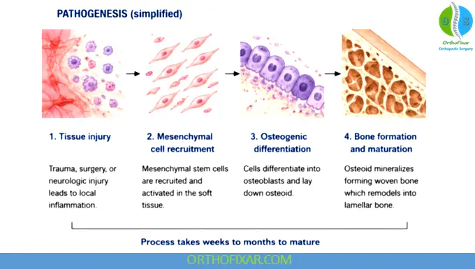Heterotopic Ossification: Pathophysiology, Classification, Diagnosis & Treatment 6 Heterotopic ossification pathogenisis