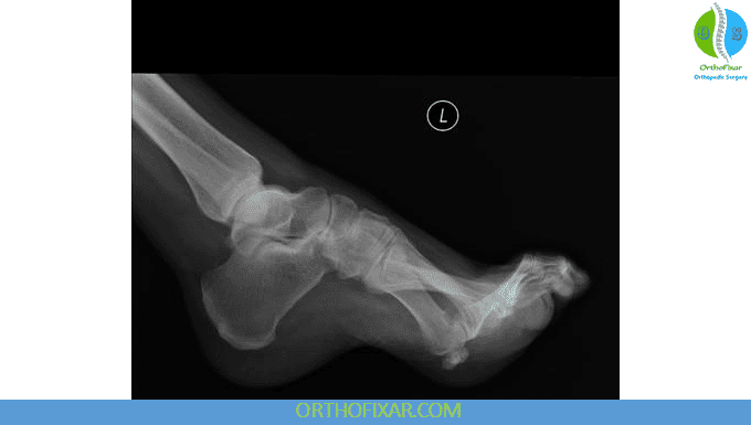 High Arches of the Foot: Symptoms, Causes, Insoles & Treatment 5 High Arches of the Foot xray