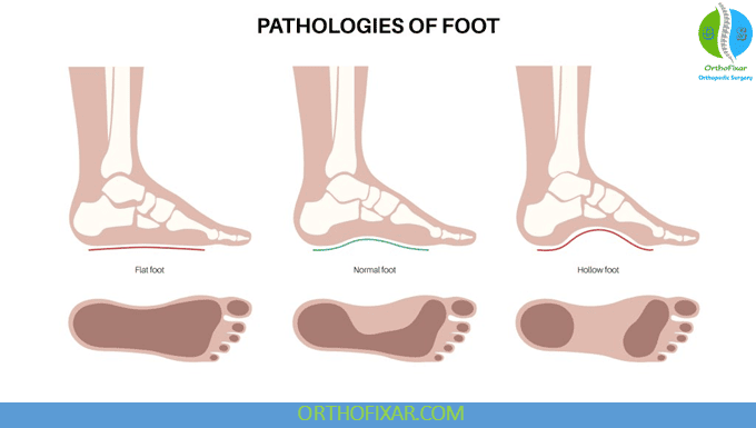 High Arches of the Foot: Symptoms, Causes, Insoles & Treatment 4 High Arches of the Foot