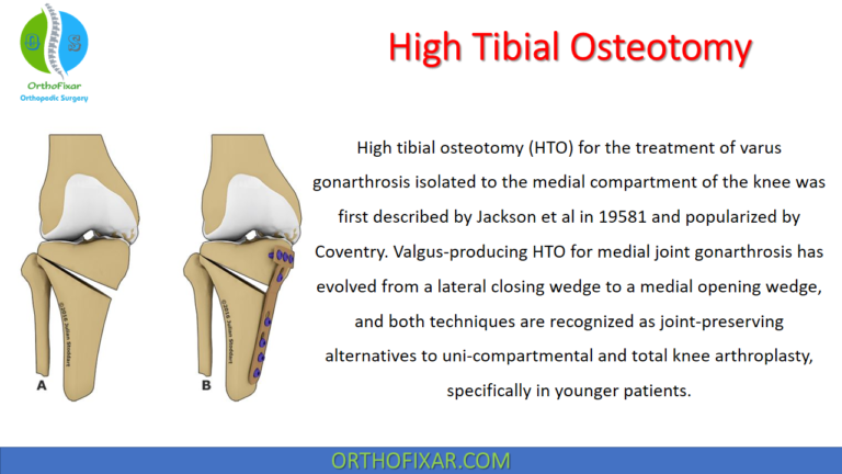 High Tibial Osteotomy