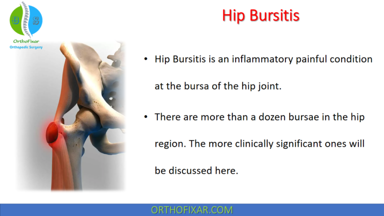 Hip Bursitis