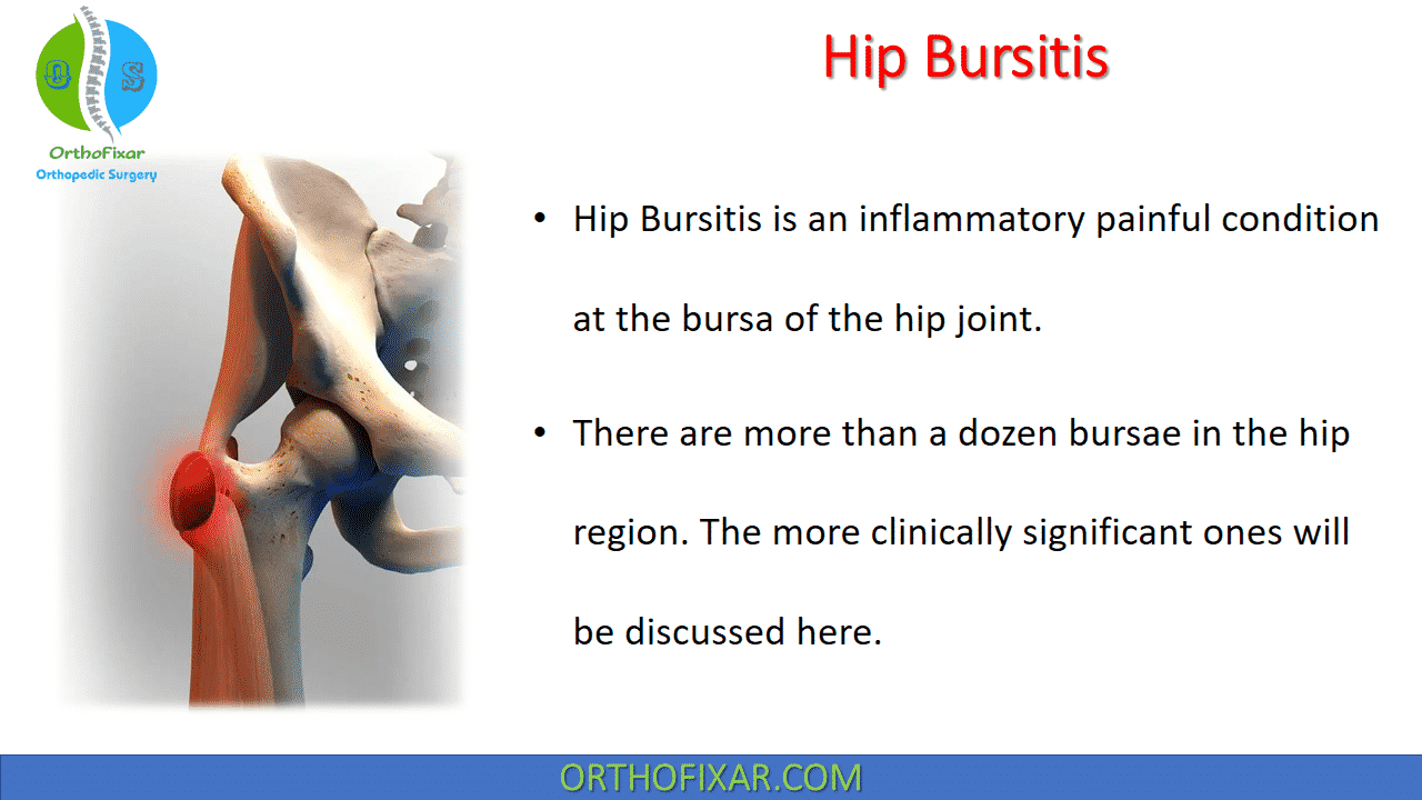  Hip Bursitis | Trochanteric Bursitis 