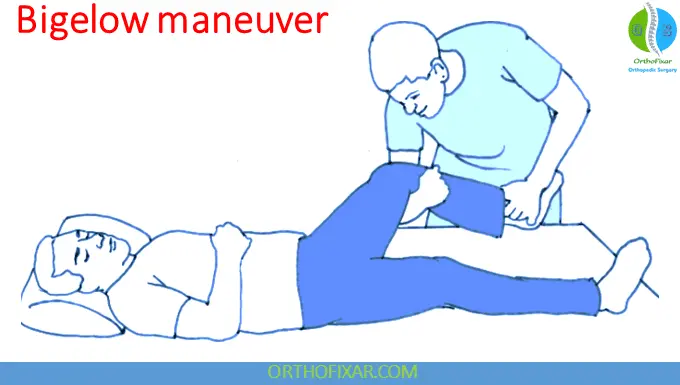 Hip Dislocation reduction - Bigelow Maneuver