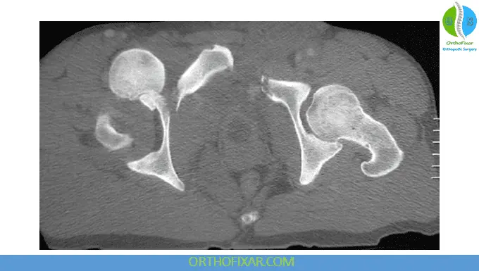Hip Dislocations CT