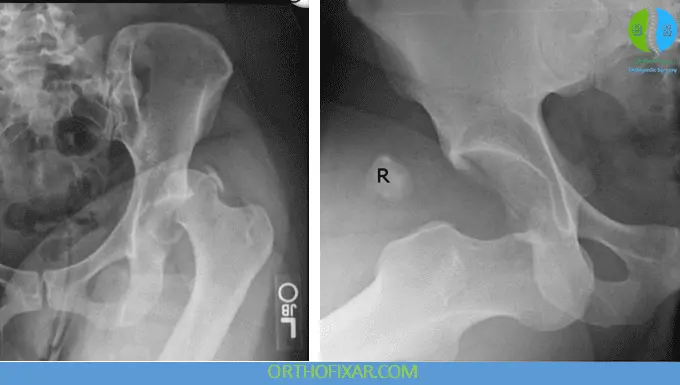 Hip Dislocations xray