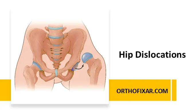 Hip Dislocations