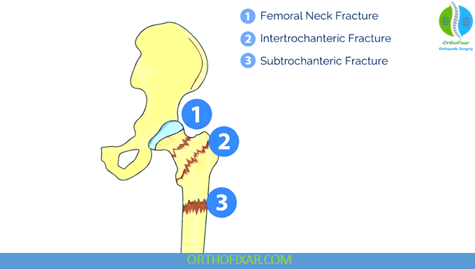 Hip Fracture: Symptoms, Surgery, Recovery & Complications 4 Hip Fracture types