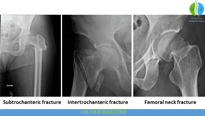 Hip Fracture: Symptoms, Surgery, Recovery & Complications 5 Hip Fracture xray